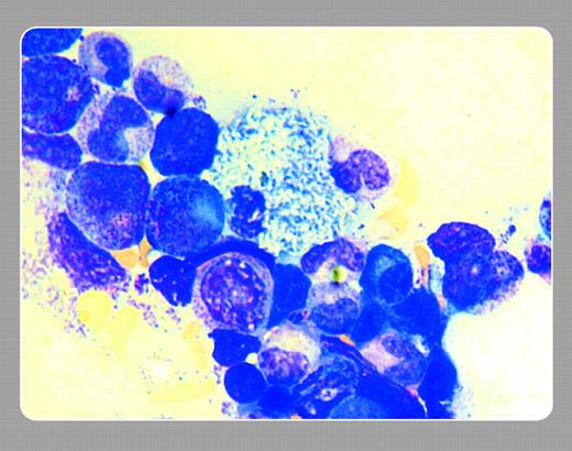 Neil Abramson, Baptist Cancer Institute