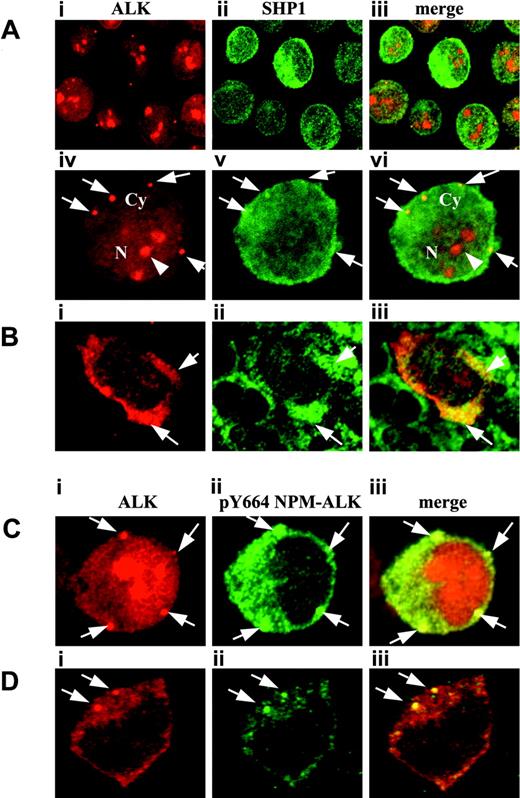 Figure 3. Confocal microscopy showing colocalization of SHP1 and phosphorylated NPM-ALK into cytoplasmic granules. (A) Karpas 299 cells (A, low-power magnification; C, high-power magnification) and tissue sections (B,D) from the ALCL tissue microarrays were stained with ALK1 and anti-SHP1 (A-B) or with ALK1 and anti-pY664 NPM-ALK (C-D) antibodies. Antibody binding was visualized with conjugated goat antimouse or goat antirabbit, respectively, as described in “Materials and methods.” ALK1 antibody (red) shows diffuse and granular (arrows) cytoplasmic (Cy) staining associated with a strong nuclear (N) and nucleolar (arrowhead) staining (Ai,Aiv,Bi,Ci,Di). Comparable cytoplasmic staining pattern is observed after SHP1 staining (Aii,Av,Bii,Cii,Dii) and the 2 signals are colocalized (merge; Aiii,Avi,Biii, Ciii,Diii). Note that SHP1 (green) is essentially detected in the cytoplasm with a weak associated nuclear staining. Anti–NPM-ALK phosphorylated on Y664 staining (green) is restricted to the cytoplasm and clearly concentrated into cytoplasmic granules (arrows; C-D). The colocalization of the 2 signals is shown (Ciii,Diii). Note that a comparable cytoplasmic staining is seen on Karpas cells (C) and on tissue sections (D) after staining with ALK1 and anti-pY664 NPM-ALK antibody. Results shown are representative of 3 independent experiments. Total magnification is 63 × for Ai-iii; 170 × for Aiv-vi and all subpanels of B, C, and D.