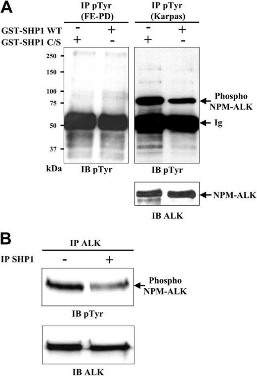 Figure 4. NPM-ALK dephosphorylation by SHP1 in vitro. (A) Antiphosphotyrosine immunoprecipitates were performed from 107 Karpas 299 cells (right panel) and FE-PD cells (left panel) pretreated with orthovanadate (500 μM for 1 hour). Immunoprecipitated phosphoproteins were incubated in phosphatase buffer with GST-SHP1 WT or GST-SHP1 C/S fusion proteins for 1 hour at 30°C and submitted to antiphosphotyrosine immunoblotting (top panels). The membrane was reprobed with the ALKc antibody to assess NPM-ALK loading (bottom panel). Data are representative of 3 independent experiments. (B) NPM-ALK immunoprecipitates from 107 Karpas cells, pretreated with orthovanadate, were incubated in the same PTP assay conditions (see above), with or without SHP1 immunoprecipitates performed on untreated Karpas 299 cells. Proteins in immune complexes were separated by SDS-PAGE and immunoblotted with antiphosphotyrosine antibody (top panel). Note that an equal amount of NPM-ALK was immunoprecipitated in each experiment (bottom panel). The data are representative of 2 independent experiments.