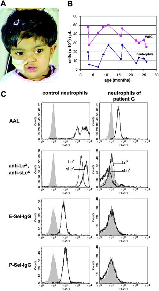 Figure 1. Clinical phenotype, blood-cell counts, and fucosylation in neutrophils of patient G. (A) Patient G at the age of 26 months. A broad and depressed nasal bridge and divergent strabismus are present. Gastric tube feeding is necessary. (B) Peripheral total white blood cell (WBC) and neutrophil counts of the patient during the first 2 years of life. Total WBC counts were permanently elevated. (C) Fucosylation and selectin ligand expression in neutrophils of the patient. Healthy and patient neutrophils were incubated with the fucose-specific Aleuria aurantia lectin (AAL), anti-Lex, or anti-sLex antibodies, and selectin-IgG (Sel-IgG) chimeric proteins, respectively, before they were analyzed by flow cytometry. Negative controls were secondary antibody only (for AAL), control IgM antibody (for anti-Lex and anti-sLex antibodies) and VE-cadherin-IgG (for selectin-IgG), respectively.