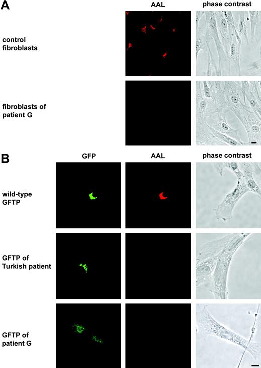 Figure 3. The GFTP of the new LAD II patient is nonfunctional. (A) Fibroblasts derived from a healthy control donor and from patient G were stained with AAL. Perinuclear fucoslyation in the Golgi is seen in healthy but not in patient cells. (B) Complementation of LAD II fibroblasts with green fluorescent protein (GFP)–tagged GFTPs of a healthy donor (wild-type), the Turkish LAD II patient, and patient G, respectively. Cells were double-stained with anti-GFP and AAL. One representative experiment of 6 is shown. Bars represent 10 μm.