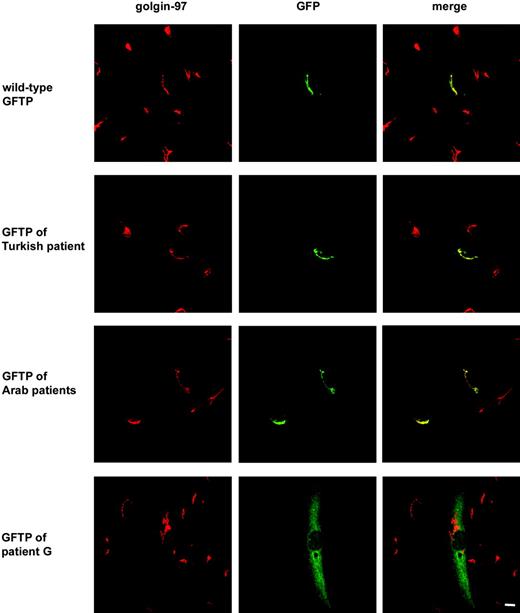 Figure 4. The GFTP of patient G does not localize to the Golgi. Fibroblasts derived from LAD II patient G were transiently transfected with GFP-tagged GFTPs from a healthy donor, the Turkish LAD II patient, 3 Arab LAD II patients, and patient G, respectively. Cells were double-stained with anti-GFP antibodies and antibodies against the Golgi protein golgin-97. One representative experiment of 3 is shown. Bar represents 10 μm.