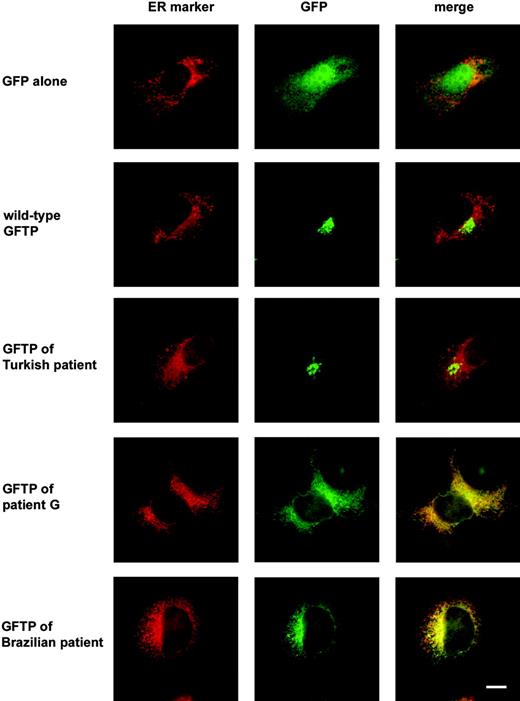 Figure 5. The truncated GFTPs of 2 LAD II patients localize preferentially to the ER. COS-7 cells were transfected with GFP-tagged GFTPs of a healthy individual and of the indicated LAD II patients together with vector pDsRed-ER coding for an ER-resident fluorescent protein. Cells were stained with anti-GFP antibodies. One representative experiment of 3 is shown. Bar represents 10 μm.