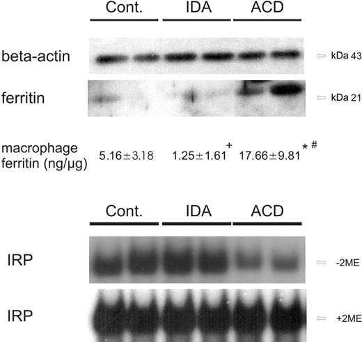 Figure 4. IRP binding activity and ferritin protein levels in circulating monocytes. (A) Freshly isolated blood monocytes were subjected to cell-extract preparation and subsequent Western blotting for quantification of ferritin protein expression. β-actin was used as an internal control. One of 4 representative experiments is shown. In addition, intracellular ferritin concentrations of monocytes were determined by ELISA technique. The means ± SD are shown for 15 control, 9 IDA, and 13 ACD patients. Results are expressed as ng ferritin per μg total monocyte protein. *P < .001 or +P < .005 when comparing controls with ACD or IDA patients by means of Student t test, respectively; #P < .001 for comparison of ACD with IDA subjects. (B) Cellular extracts from corresponding monocytes were analyzed for IRP binding affinity by means of band shift assays. IRP binding affinity in monocytes of controls, IDA, and ACD patients is shown in the top panel. The total IRP binding capacity was determined by preincubation of extracts with 2-mercaptoethanol (+ 2-ME, bottom panel). One of 6 representative experiments is shown.
