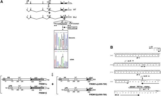 Figure 4. RNA splicing aberrations associated with point mutation at the exon 6/intron 6 junction. Diagrammatic depiction of aberrant splicing in tumor no. 4 due to RNA editing. Both the wild-type (WT) and abnormally spliced transcripts (MUT) are shown (Figure 3Aii). The point mutation in the consensus splice donor sequence (underlined) at the exon 6/intron 6 junction (u → a at position +2) is indicated, along with the sequence chromatogram of cDNA showing the editing U(T)-to-A conversion absent in genomic DNA. The cryptic splice donor site in intron 6 used in the tumor is shown in italics. The 49-bp intron 6 sequence inserted in the tumor transcripts and the resulting premature translation termination are indicated. The predicted structures of PRDM1α and PRDM1β are shown along with their functional domains. Both wild-type and truncated PRDM1 proteins are expected to be produced. (B) Partial cDNA nucleotide sequence of transcripts showing retention of intron 6 sequence in tumor no. 4. The U(T) → A point mutation inactivating the normal consensus splice donor site (underlined) at the exon 6/intron 6 junction is indicated. The intron 6 cryptic splice donor site and the splice acceptor site at the intron 6/exon7 junction used in the tumors are in italics. The retained 49-nt intron 6 sequence is shown (solid arrow), and the distance between its 3′ end and the 5′ end of exon 7 is indicated (362 bp). The premature translation termination codon and the novel peptide sequence predicted from the intron 6 sequence are in bold and italics, respectively. The first 2 zinc fingers (ZF1 and ZF2) that remain in the truncated protein are boxed, with their boundaries marked by arrowheads. A minority of the transcripts used an upstream cryptic splice donor site (dotted underline) and retains only the first 18 nucleotides of intron 6 (see text). The encoded protein is not truncated and has an additional 6 amino acids (ERSIFW).
