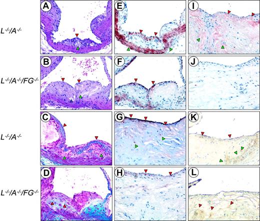 Figure 4. Histology of the aortic sinuses from mice at various ages. Sections were cut from 24-week (A,C,E) and 48-week (G,I,K) L–/–/A–/–, and from 24-week (B,D,F) and 48-week (H,J,L) L–/–/A–/–/FG–/– mice. H&E (A,B) and Masson's trichrome stains (C,D), and anti-SMC (E,F,G,H), antifibrin(ogen) (I,J), and antimacrophage immunostains (K,L). Original magnification, × 200. (A) A well-formed fibrous cap (red arrowhead) encapsulating a foam cell-laden core (green arrowhead). (B) An intermediate size lesion with a thinning cap (red arrowheads). Focal acellular patches (green arrowhead), cellular debris, extracellular lipids, foam-like cells, and cholesterol clefts (blue arrowhead) within the core. (C) The collagen-rich fibrous cap (red arrowheads) encapsulates a collagen-negative foam cell core (green arrowheads). (D) Collagen is associated within the subcapsular region (red arrowheads). (E) A cellular multilayered region of SMCs associated with the fibrous cap (red arrowheads), as well as the normally positive medial compartment (green arrowheads). (F) Numerous single-layered positive SMCs (red arrowheads) at the endothelium. (G) Positive (dark red) SMC cells in the subluminal region, which are intensely positive (red arrowheads) and diffusely scattered among negative bordering cells. A few positive SMCs within the core (green arrowheads). (H) A thin, faint SMC layer (red arrowheads) in the subluminal region diffusely scattered among negative bordering foci. (I) Fibrin deposits (red staining) in the underlying subcapsular region. Patchy areas of fibrin are associated with the endothelium (red arrowheads). Diffuse areas of fibrin deposition in the lipid core (green arrowheads). (J) Negative anti-Fg immunostaining. (K) Macrophages (brown stain) in the thinned cap, in the subendothelium (red arrowheads), and within the lipid core (green arrowheads). (L) Several macrophages (brown stain) diffusely scattered within the core and at the base (red arrowheads).