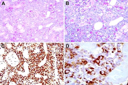 Figure 1. Tumor histology. Myelomonocytic tumor cells with large round nuclei and a variable amount of cytoplasm infiltrate extensively in the left kidney, intercalating between renal tubular cells, shown via hematoxylin and eosin staining, original magnification, × 20 (A) and × 40 (B). Immunohistochemical stains using EnVision Plus from Dako (Carpinteria, CA) as the detection system with chromogen diaminobenzidine (DAB), showed that these cells were uniformly strongly positive for the proliferation marker MIB-1 (original magnification, × 40) (C). The cells were positive for myeloperoxidase (MPO), supporting their myeloid origin (original magnification, × 100). Images were visualized under an Olympus BX41 microscope equipped with an Olympus UPlan Fl 20 ×/0.50 (∞/0.17) (A), 40 ×/0.75 (∞/0.17) (B,C), or 100 ×/1.30 (oil) (D) objective lens (Olympus, Melville, NY). A U-TV 0.5 × C connector was used. Images were captured with an Olympus DP12 digital camera, digitally acquired with an Olympus UBS SmartMedia Reader-Writer, and processed with Photoshop 7.0 software (Adobe Systems, San Jose, CA).
