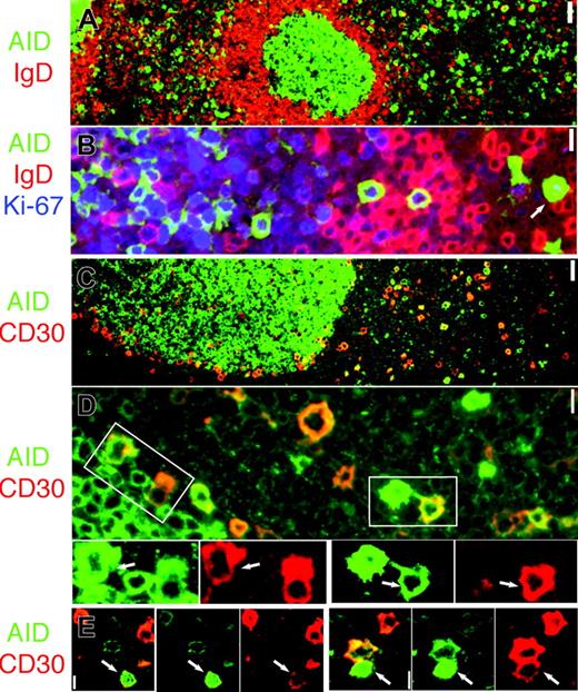 Figure 2. Proliferating IgD– AID+ cells and CD30+ B-cell partially overlap. (A) AID (green) and IgD are mutually exclusive. Original magnification ×4. (B) AID+ cells (green) are IgD– (red) and proliferate (Ki-67+, blue). Note nuclear AID+ extrafollicular cell (arrow). Original magnification ×40. (C) AID (green) and CD30 (red) are partially overlapping subsets. (D) Occasionally, AID+ (green) and CD30+ (red) double-positive cells can be seen outside and at the periphery of the GC. The areas marked by white rectangles are enlarged and colors are split below. Double-positive cells are indicated (arrows). Original magnification × 40. (E) Two representative nuclear AID+ (green) and CD30+ (red) extrafollicular cells are shown (arrows). Merged images show orange color where coexpressed. Original magnification × 40. Scale bar: 1 μm at ×40, 4 μmat ×10, and 10 μmat ×4.