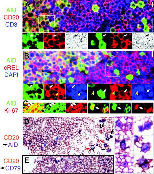 Figure 3. Nuclear AID is detected inside and outside the GC. (A) AID+ cells (green) express membrane CD20 (red; orange color when coexpressed) and are surrounded by CD3+ cells (blue) outside the GC. Several nuclear AID+ extrafollicular blasts (right, arrow) and small centroblasts (left) are shown. The areas marked by white rectangles are magnified below; the color split and phase contrast image of the same field were added. Original magnification ×40. (B) AID+ GC cells are strongly cytoplasmic cREL+ (red) in the GC (left field, orange color when coexpressed). Nuclei are counterstained with DAPI. The areas marked by white rectangles (GC on the left; extrafollicular on the right) are magnified below; the color split and nuclear AID+ cells are marked by a white arrow. Note the total absence of nuclear cREL in the nAID+ cells, while nuclear cREL+ nAID– cells (yellow arrowhead) are shown nearby. Original magnification ×40. (C) Confocal microscopy of AID (green) and Ki-67 (red) costained tonsil shows nuclear coexpression (yellow; arrows) in small centroblasts (left) and extrafollicular blasts (right). (D) Prior staining for CD20 (brown) prevents cytoplasmic AID staining, except in 2 AID+ CD20 ± extrafollicular blasts (red arrows). Nuclear AID (purple) can be shown in extrafollicular cells (black arrows) and in centroblasts (blue arrows). On the right, nAID+ centroblasts (left column) and large extrafollicular cells (right column) are shown, enlarged. Original magnification ×40.(E) As a control, no nuclear staining is shown in CD20 (brown) and CD79a (purple) double-stained tonsil. Original magnification ×40. Scale bar: 1 μm at × 40, 4 μm at ×10, and 10 μmat ×4.