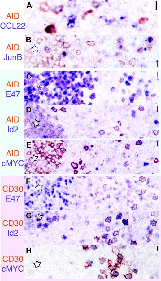 Figure 5. The transcription signature of AID+ and CD30+ B cells. AID is red-brown; the other marker is purplish in each image. Original magnification ×40.(A) A subset of AID+ cells display dotlike CCL22 positivity. (B) AID and JunB are largely nonoverlapping. (C-E) AID+ cells (red brown) inside and outside the GC (star) are E47+, Id2–, and largely cMYC–. (E-G) By comparison, CD30+ cells (red brown) show a reversed staining pattern, being E47– but Id2+ and cMYC+. Scale bar: 1 μm at ×40, 4 μmat ×10, and 10 μmat ×4.