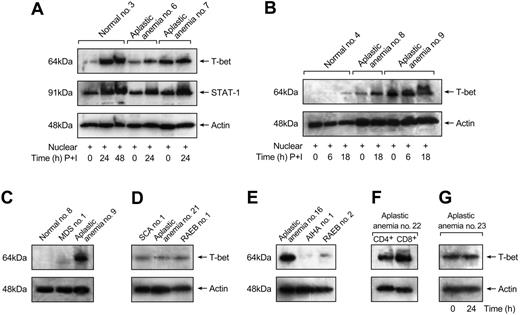 Figure 2. Stimulation induces T-bet expression in healthy controls but not in aplastic anemia patients. (A) Stimulation conditions with PMA and ionomycin did not have any effect on T-bet levels in patients with aberrant expression of T-bet (patient no. 7). In patients with lower T-bet levels, stimulation induced further T-bet expression (patient no. 6). No significant differences in STAT1 protein levels were detected between aplastic anemia patients and controls. (B) Healthy controls did not express T-bet in unstimulated T cells. T-bet expression was induced after stimulation with PMA and ionomycin. Stimulation conditions induced T-bet expression in patients with lower T-bet protein levels (aplastic anemia no. 8). (C-E) Patients with myelodysplastic syndrome (MDS), refractory anemia with excess of blasts (RAEBs), sickle cell anemia (SCA), and autoimmune hemolytic anemia (AIHA) showed undetectable T-bet levels in immunoblot experiments comparable with healthy controls and patients in remission (patient no. 21). (F) CD8+ T cells express increased T-bet levels compared with CD4+ T cells. (G) T-bet protein levels are not affected by in vitro maintenance after 24 hours without T-cell stimulation.