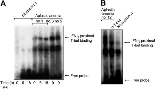 Figure 3. T-bet binds to the proximal site of the IFN-γ promoter in patients with aplastic anemia. (A) Nuclear extracts from healthy controls and patients were examined in EMSA experiments using an oligonucleotide that spans from –75 to –45 bp on the human IFN-γ promoter site (proximal IFN-γ promoter site). Unstimulated extracts from aplastic anemia patients revealed increased T-bet binding. In patients with lower T-bet protein levels (patient no. 1, Figure 1B) this binding was induced after stimulation. No binding could be detected in unstimulated nuclear extracts from healthy controls. (B) The binding observed in unstimulated extracts from aplastic anemia patients was decreased in supershift experiments using a T-bet mAb, indicating binding specificity.