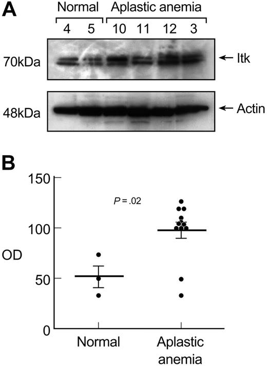 Figure 5. Itk protein levels correlate with T-bet expression in aplastic anemia patients. (A) Cytoplasmic extracts from unstimulated T cells from patients with aplastic anemia (n = 12) and healthy controls (n = 3) were examined in immunoblot experiments for Itk expression. T cells from patients revealed increased Itk protein levels compared with healthy controls. The elevated Itk protein levels correlated with the increased T-bet protein levels observed in the same patients. Patient no. 11, a patient in remission, showed Itk protein levels comparable with healthy controls and did not express any T-bet in unstimulated T cells (data not shown). (B) Densitometric intensity of all the subjects studied is shown. The differences in Itk protein levels expressed in aplastic anemia patients and controls in unstimulated T cells were significant (P = .02). Horizontal lines represent mean values.