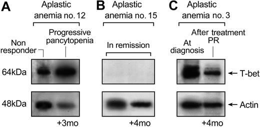 Figure 8. T-bet protein levels correlate with disease activity. Patients were re-examined for T-bet levels 3 to 4 months after they were first examined for T-bet expression. In patients whose disease status was unchanged, there were no differences in T-bet expression. In patients who had responded to treatment, T-bet levels were lower. (A) Patient no. 12, who relapsed when first studied, by 3 months had progressive pancytopenia, and T-bet levels were elevated at both time points. (B) Patient no. 15 was in remission and continued in remission 4 months later; no T-bet could be detected at either occasion. (C) Patient no. 3 was at diagnosis when there was high expression of T-bet; 4 months later, response to treatment was associated with lower levels of T-bet.
