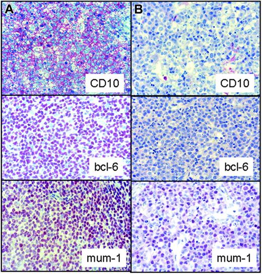 Figure 1. Immunohistochemical example of aGCB subtype of DLBCL that is positive for the germinal center markers CD10 and bcl-6 and co-expresses MUM-1. (A) A rare case of pediatric DLBCL with a non-GCB immunophenotype with negative staining for CD10 and bcl-6 and positivity for MUM-1 (B). Images were captured with a Zeiss Axioskop 40 microscope (Carl Zeiss, Jena, Germany) equipped with a 40×/0.75 objective lens and an RT slider camera (Diagnostic Instruments, Sterling Heights, MI). Images were processed with MetaVue software (Diagnostic Instruments) and Adobe Photoshop (Adobe Systems, San Jose, CA).