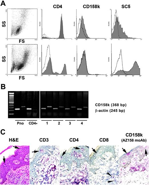 Figure 1. Expression of CD158k and VIM by circulating and cutaneous lymphocytes. (A) Flow cytometry analysis in patient 11 showed CD158kdim and cell-surface VIM positivity before treatment (top row). After treatment with extracorporeal photochemotherapy, there was a dramatic decrease in the CD4+ population associated with a loss of CD158k expression and a significant increase in VIM (bottom row). (B) RT-PCR for CD158k was positive for PBMCs in patients 1, 2, 3, and 4 and for the Sézary cell line Pno, whereas it was negative for CD4+ lymphocytes in a healthy donor. (C) Immunohistochemistry analysis performed in a skin sample from patient 3 showed a predominantly CD3+CD4+ infiltrate along with CD158k+ cells in the dermis and the epidermis. Intraepidermal nests of lymphocytes, or Pautrier microabscesses, can be seen (arrows). Few CD8+ lymphocytes were present in the dermis (arrowheads), whereas only CD4+ T cells are seen in the epidermis. Slides are shown at 200 × original magnification (20 ×/0.50 NA objective), and images were captured with an Axioskop2 microscope (Zeiss, Oberkochen, Germany). Pictures were scanned in with a DP70 camera and software (Olympus, Hamburg, Germany). Hematoxylin and eosin staining is shown on the left, whereas a biotin/avidin system conjugated to alkaline phosphatase was used for CD3, CD4, CD8, and CD158k labeling.