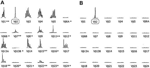 Figure 2. Immunoscopy applied to PBMCs and a skin specimen of patient 2: TCR Vβ spectratyping. (A) GeneScan Analysis of PBMCs in patient 2 revealed a monoclonal signature for Vβ2 (shown to be malignant by 2-color flow cytometry analysis), apparent loss of several families (*) and many contracted profiles (**). (B) Gene-Scan Analysis of a skin sample from the same patient revealed a complete loss of all Vβ families, with a single monoclonal peak of a size identical to that of the malignant T-cell clone identified in the blood, indicating the presence of the malignant T-cell clone in the skin and the complete loss of other T cells.