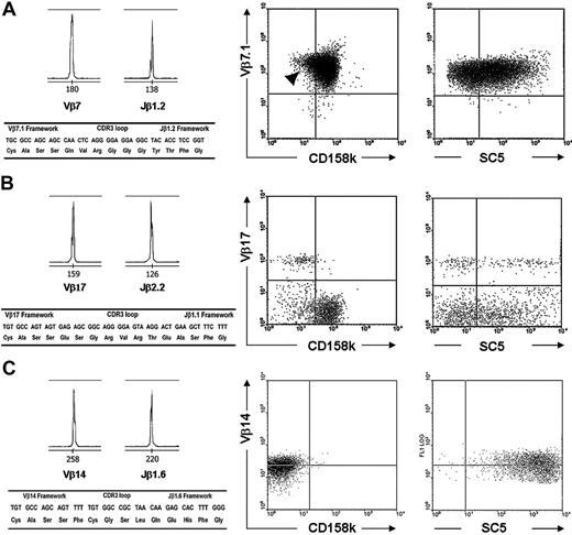 Figure 3. Identification of malignant and nonmalignant T-cell clones in patients 4, 8, and 10 using TCR Vβ, CD158k, and cell-surface VIM phenotyping. Molecular characteristics of the T-cell clones are shown on the left, and the results of 2-color flow cytometry analyses are shown on the right. (A) A strongly expanded TCR Vβ7-Jβ1.2 T-cell clone was identified in patient 4, expressing CD158k and displaying heterogeneous labeling with SC5 mAb. A minor CD158k– population could be recognized within the Vβ7+ population (arrowhead). (B) A nonmalignant TCR Vβ17-Jβ2.2 T-cell clone was identified in patient 8, accounting for 10% of gated lymphocytes. Two-color flow cytometry showed that the TCR Vβ17+ population displayed heterogeneous expression of cell-surface vimentin (SC5) but was negative for CD158k. (C) A nonmalignant TCR Vβ14-Jβ1.6 T-cell clone was identified in patient 10 during treatment with anti–CD52 mAb (alemtuzumab) that was heavily expanded and did not express CD158k, as seen on the right based on the results of 2-color flow cytometry.