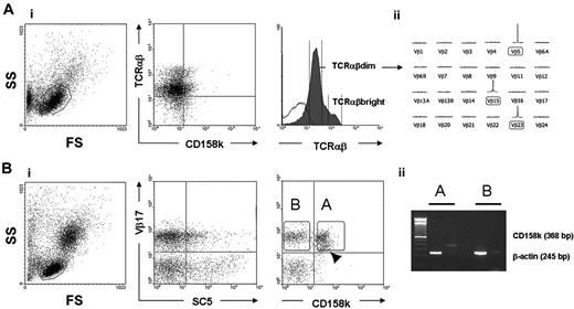 Figure 4. Intraclonal heterogeneity for CD158k and TCR Vβ expression in patients 1 and 13 and cell sorting analysis. (Ai) Patient 13 showed 2 distinct TCRαβdim and TCRαβbright circulating T-cell populations. Two-color flow cytometry showed that CD158k+ cells were present within both T-cell populations. (Aii) GeneScan Analysis applied to sorted populations revealed that the TCRαβdim population only disclosed clonal TCR Vβ5, TCR Vβ15, and TCR Vβ23. In contrast, the TCRαβbright population had a profile similar to that of whole PBMCs, including clonal TCR Vβ5, Vβ23, and Vβ15, suggesting that malignant and nonmalignant T-cell clones were present in the TCRαβbright and TCRαβdim subsets. (Bi) Two-color flow cytometry revealed heterogeneity for CD158k expression within the malignant TCR Vβ17 population in patient 1. A proportion of Vβ17+ cells did not express CD158k. A minor Vβ17dim subpopulation could be recognized within the TCR Vβ17+ CD158k+ population (arrowhead). (Bii) Through RT-PCR, CD158k mRNA was detected at significant levels in the TCR Vβ17+ CD158k+ population; negative results were obtained in the TCR Vβ17+ CD158k– population.