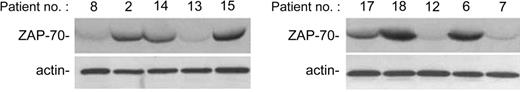 Figure 3. Analysis of ZAP-70 expression in B-CLL patient cells. ZAP-70 expression has been evaluated by Western blot on CD19+ purified B-CLL cells. Representative examples of patients characterized by absent/low (nos. 8, 13, 12, 7) and intermediate/high (nos. 2, 14, 15, 17, 18, 6) ZAP-70 levels are shown.