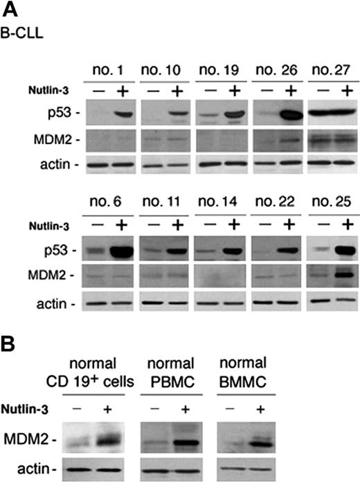 Figure 4. p53 and MDM2 induction in B-CLL and in normal cells in response to nutlin-3. B-CLL cells (A) and normal CD19+ B lymphocytes, PBMCs, and BMMCs (B) were incubated with or without nutlin-3 (10 μM) for 24 hours before analysis of p53 and MDM2 by Western blot. (A) Representative samples from patients characterized by absent/low (nos. 1, 10, 19, 26, and 27) and intermediate/high (nos. 6, 11, 14, 22, 25) ZAP-70 levels, showing a variable induction of p53 and a low frequency of MDM2 induction (nos. 26, 25), are reported. High constitutive and unmodified level in patient no. 27 indicates p53 mutation. (B) Representative results of 3 to 6 independent experiments are shown.