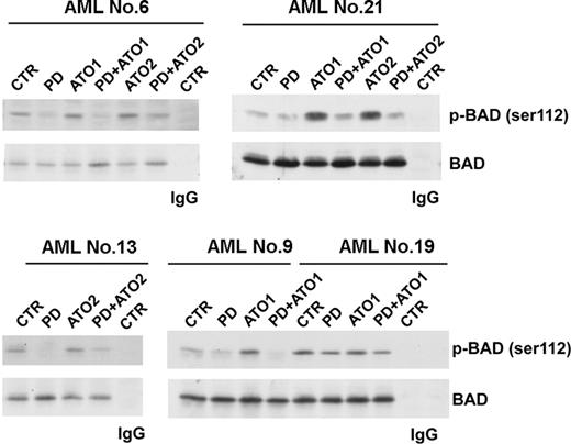 Figure 2. Effects of combined MEK inhibition and ATO treatment on Ser112 Bad phosphorylation and Bad protein levels in AML blasts. For the analysis of Bad phosphorylation, lysates were immunoprecipitated with rabbit polyclonal anti-Bad or with a control antibody, and the immunoprecipitated samples were subjected to 15% sodium dodecyl sulfate–polyacrylamide gel electrophoresis (SDS-PAGE) followed by Western blot analysis with the anti–phospho-Ser112-Bad antibody. Filters were then stripped and reprobed with the anti-Bad antibody.