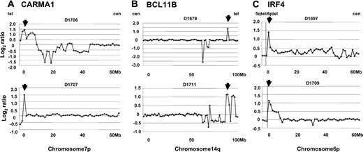 Figure 3. Individual genome profiles of amplification at 6p, 7p, and 14q. Although there were only 2 lymphoma-type cases with high copy number gains, 3 regions are shown because they contained genes implicated in lymphomagenesis. No high copy number gains were found in acute-type cases. (A) Individual genome profiles of high copy number gains at 7p22.2 for 2 patients (D1706 and D1707). Horizontal lines indicate the megabase (Mb) from the 7p telomere to the centromere, and vertical lines show the log2 ratio. Spots are ordered contiguously from the p telomere to the centromere, with an average resolution of 1.3 Mb. The threshold for gain and loss was defined as a log2 ratio of +0.2 and –0.2, respectively. The arrow above each graph represents the highest peak at 7p22.2. RP11-498D18 located in the peak contains CARMA1. (B) Individual genome profiles of high copy number gains at 14q32 for 2 patients (D1678 and D1711). Spots are ordered contiguously from the 14q centromere to the 14q telomere. The arrow above each graph represents the highest peak at 14q32. RP11-1127D7 located in the peak is 0.3 Mb telomeric to BCL11B. (C) Individual genome profiles of high copy number gains at 6p25 for 2 patients (D1697 and D1709). Spots are ordered contiguously from the 6p telomere to the 6p centromere. The arrow above each graph represents the highest peak at 6p25. RP11-233K4 located in the peak contains IRF4. Based on information from the Ensembl Genome Data Resources of the Sanger Center Institute and NCBI. Vertical dotted lines represent the boundary between 5q and 6q telomeres.