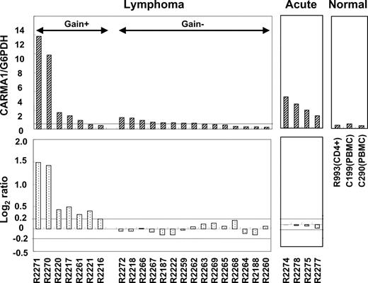 Figure 4. RQ-PCR for CARMA1 and correlation of genomic amplification. RQ-PCR was used to detect the expression level of CARMA1 in ATLL patients with or without 7p22 gain/amplification. Twenty lymphoma-type cases were divided into 2 groups, 1 group with copy number gain/amplification (gain +) and the other group without any copy number change (gain –). The top panels show expression levels of CARMA1 determined by RQ-PCR, while the bottom panels indicate genomic profiles determined by array CGH. The horizontal dotted line in the top left panel in the gain group indicates the mean value (0.603) of the expression level (SD, 0.312). Four patients with acute-type ATLL are represented in the center panels. For comparison, 1 sample of CD4+ T cells isolated from peripheral blood mononuclear cells (PBMCs) and 2 samples of PBMCs were examined by RQ-PCR (right panels).