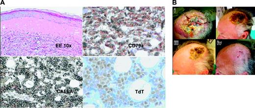 Figure 1. Cutaneous response to BMS-354825. (A) Skin biopsy shows cutaneous involvement by precursor B cells; neoplastic cells diffusely infiltrate the dermis. Hematoxylin-eosin staining. Low magnification, × 10. At immunohistochemistry, the lymphoblasts express B-cell markers as CD79a, precursor B-cell marker CD10-CALLA, and show nuclear staining for TdT. Images were obtained with a Nikon Eclipse E600 microscope (Nikon, Tokyo, Japan) with 10 ×/0.25 NA and 40 ×/0.65 NA brightfield objectives, acquired with a JVC TK 1270 color video camera (JVC, Tokyo, Japan), and AVer E-Z Capture software (AVerMedia, Milpitas, CA). Images were processed with Paint Shop Pro 7.0 (Jase Software, Eden Prairie, MN). CD79a, CALLA, and TdT are from Dako (Glostrup, Denmark). (B) Patient with cutaneous infiltrate of acute lymphoblastic leukemia resistant to previous treatments. In panel Bi, presence of multiple dermohypodermal nodules with a central ulceration pre–BMS-354825 therapy. In panels Bii-iii the same lesion 1 and 2 weeks after starting therapy. Four weeks after treatment, the scalp lesion was completely healed with only the presence of a hypopigmentated scar (Biv). Pictures were taken using a Panasonic Lumix 2MC-FX5 (Panasonic, Osaka, Japan) digital camera and processed with Paint Shop Pro 7.0.