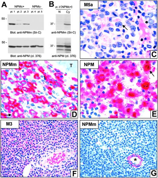 Figure 5. NPM mutants localize exclusively in the cytoplasm of leukemic cells. (A-B) Western blot analysis (Sil-C vs 376 mAb) of whole-cell lysates from either NPMc+ or NPMc– AML cells (A) and of nuclear (N) and cytoplasmic (Cy) cell fractions from a patient with AML bearing NPM mutation A (B). Sil-C recognizes specifically the mutated NPM protein in the cytoplasmic fraction of NPMc+ primary leukemic cells. Results are representative of at least 3 independent experiments. (C-E) Bone marrow biopsy from a NPMc+ AML bearing mutation A. (C) Typical appearance of FAB-M5a type AML; the arrow points to a large leukemic cell with kidney-shaped nucleus. (D) The Sil-C antibody that recognizes specifically the NPM mutant (NPMm) shows a cytoplasmic-restricted positivity of leukemic cells (arrow); T indicates a bone trabecula. (E) Monoclonal anti–NPM 376 that recognizes both the wild-type and mutant NPM proteins labels leukemic cells both in the cytoplasm and the nucleus (arrow). (F-G) Bone marrow biopsy from a case of promyelocytic leukemia lacking NPM mutations (NPMc–). (F) Typical appearance of AML FAB-M3 (hematoxylineosin). (G) The Sil-C antibody does not stain leukemic cells (devoid of mutated NPM protein) and only cross-reacts with a vessel wall; the asterisk indicates the lumen of the vessel (APAAP technique; hematoxylin counterstain). Images were collected using an Olympus BX51 microscope and a UPlanFl 100 ×/1.3 NA oil (C-E) or a UPlanApo 40 ×/0.85 (F-G) objective.