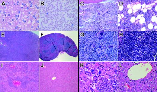 Figure 2. Histopathology of Jak2V617F and Jak2wt BM transplant models. Histology of Jak2V617F- and Jak2wt-transduced Balb/c mice showing images of PB (A-B) and pathology in representative sections of BM (C-D), spleen (E-H), and liver (I-L). PB smear (B, 600 ×; Wright-Giemsa stain) of a representative Jak2wt animal displays normal white blood cell counts with an unremarkable differential. In contrast, PB smear (A, 600 ×; Wright-Giemsa stain) of a representative Jak2V617F mutant animal reveals marked leukocytosis consisting predominantly of maturing myeloid elements. Bone marrow images from Jak2wt animals display preserved marrow architecture with normal ratios of myeloid/erythroid elements and unremarkable megakaryocytes (D, 600 ×, H&E stain). In comparison, BM sections from Jak2V617F mutant animals demonstrate marrow elements composed of a prominent population of maturing myeloid cells with mildly to moderately increased numbers of megakaryocytes, including large, atypical forms occurring in occasional clusters (C; 600 ×, H&E stain) and showing emperipolesis of neutrophils in megakaryocyte cytoplasm. Spleen sections from Jak2V617F mice display complete effacement of normal splenic architecture (E; 40 ×, H&E stain) with a marked expansion of red pulp predominantly composed of maturing myeloid elements, frequent atypical megakaryocytes in clusters, and occasional erythroid elements (G; 600 ×, H&E stain) compared with unremarkable Jak2wt spleens (F, H; 40 ×, 600 ×, H&E stain). Liver images from Jak2V617F mice illustrate evidence of extensive extramedullary hematopoiesis in a perivascular and sinusoidal distribution (I; 100 ×, H&E stain) composed of frequent large, atypical megakaryocytes, maturing myeloid cells, and erythroid forms (K; 600 ×, H&E stain) notably absent in livers from Jak2wt animals (J, L; 100 ×, 600 ×, H&E stain).