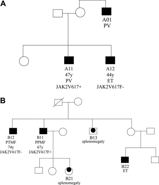 Figure 1. Pedigrees of 2 families with familial MPD. (A) Pedigree of family A. (B) Pedigree of family B. Squares indicate males; circles, females. Filled symbols indicate affected individuals; black dots within symbols, possibly affected individuals; strike through, deceased individuals.