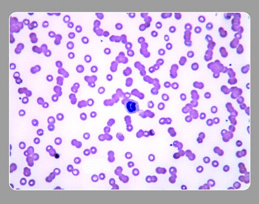 Figure 1. A 69-year-old man had lethargy and lower-back pain for several months. His physical findings showed mild congestive heart failure and no focal neurologic signs. The CBC was normal except for thrombocytopenia. Renal and hepatic function were normal. A sedimentation rate was markedly elevated, and his peripheral smear (× 40) is shown. . / The stacking of cells (rouleaux formation) facilitates the rate of red cell sedimentation, a phenomenon that may be seen on a peripheral smear. The appearance of rouleaux may be artificially caused by a poor preparation of the smear or by viewing the slide in a thickened area. When rouleaux formation is truly present, it is caused by an increase in cathodal proteins, such as immunoglobulins and fibrinogen. Although myeloma and macroglobulinemias are first considered by hematologists, other causes occur more frequently, such as acute and chronic infections, connective tissue diseases, and chronic liver disease. . / This patient also had plasma cells that were seen on the peripheral blood smear. The diagnosis was IgA myeloma (plasma cell leukemia), and it was accompanied by hyperviscosity that required plasmapheresis. . / Neil Abramson, Baptist Cancer Institute