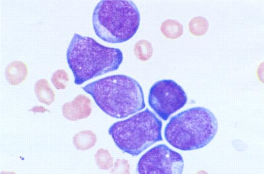 Figure 1. Photomicrograph of a blood smear of a child with DS and TL. The nucleated cells are megakaryoblasts showing small amounts of basophilic cytoplasm, distinct nucleoli, and cytoplasmic blebbing. May-Grünwald-Giemsa stain; original magnification × 1000. Photograph taken with a Zeiss photomicroscope; courtesy of A.Z.