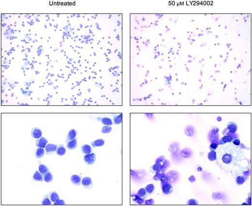 Figure 5. PI3K inhibition induces morphologic changes in T-LGL consistent with apoptosis. Untreated (control) T-LGL are noted in the left panels intermixed with occasional macrophages. The right panels show images of Wright-stained T-LGL PBMCs that had been treated for 20 hours with LY294002 (50 μM). Apoptotic cells are seen in the LY-treated T-LGL. Original magnifications: low power, × 200; high power, × 1000 (oil).