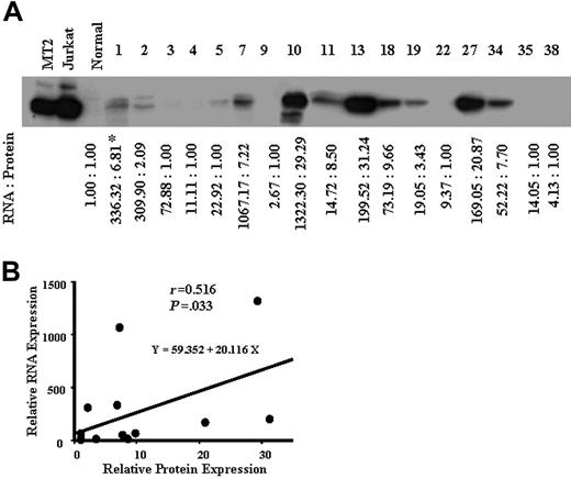 Figure 2. Protein expression of survivin in ATL. Whole-cell lysates (50 μg protein) from patients with ATL were separated by 12.5% SDS-PAGE and then transferred to a PVDF membrane. The transferred proteins were reacted with antibody against survivin (A) as described in “Patients, materials, and methods.” *Concentrations of survivin protein and mRNA are expressed relative to the survivin protein and mRNA levels in control normal cells, which were assigned values of 1. (B) A comparison between the survivin mRNA level (y-axis) and the protein expression level (x-axis) in 17 patients with ATL. The survivin mRNA level correlated with the protein level (r = 0.516, P = .033).