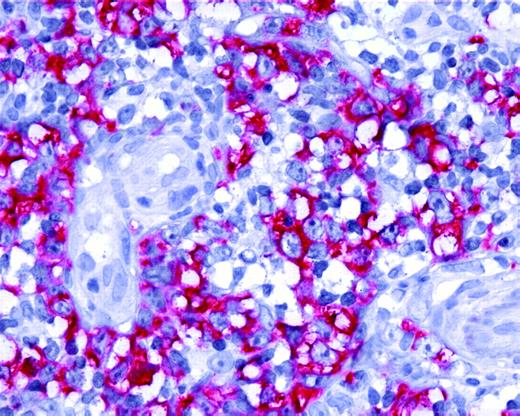 Figure 2. Expression of AID by tumor cells in PCLBCL, leg type. Neoplastic B cells of primary cutaneous large B-cell lymphoma, leg type, show positive staining for AID protein (original magnification ×40). Images were captured with a Leica DMLB microscope (Leica, Bensheim, Germany), using a Leica PL FLUOTAR objective lens (40×/0.70) and a Leica DC200 camera. Images were directly imported into Power-point (Microsoft, Redmond, WA), using the Leica DC200 camera software (version 2.51).