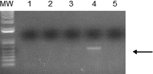 Figure 3. WT1 (–Ex5/–KTS) binds to the A1 promoter. Chromatin immunoprecipitation assays were performed as described using 32DV4 and 32DWT1 cells treated overnight with 50 μM ZnCl2. The arrow indicates the position of the PCR product representing the A1 promoter, present in the 32DWT1 sample but not in the 32DV4 sample. Lane 1 is the control with no template, lanes 2 and 5 are the no-antibody controls from 32DV4 and 32DWT1 cells, respectively, and lanes 3 and 4 are the samples from 32DV4 cells (Lane 3) and 32DWT1 cells (Lane 4). The identity of the PCR fragment was confirmed by sequencing.