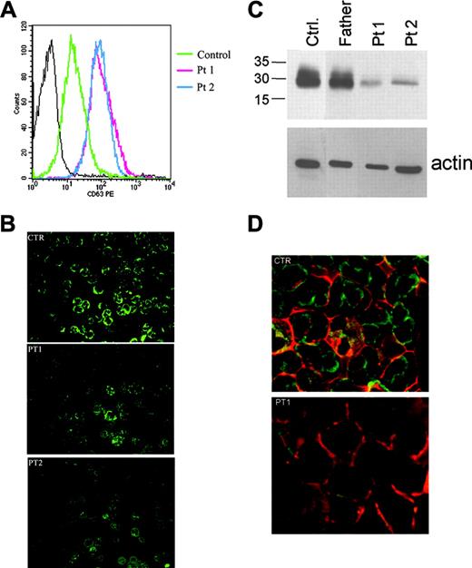 Figure 2. Increased cell surface expression of CD63 and reduced elastase levels in HPS2 patients. (A) Circulating neutrophils were separated as described in “Patients, materials, and methods,” washed twice, and analyzed by a flow cytometer for expression of CD63. CD63 staining (thick line) in comparison with mouse IgG antibody (thin line) is presented on a histogram plot. Red fluorescence intensity is shown on the x-axis expressed in a log scale; the number of cells per channel is shown on the y-axis. Experiment shown is representative of 3 independent experiments performed. (B) Immunofluorescence staining for NE in circulating neutrophils from HPS2 patients. PMN cells were obtained from peripheral blood, cytocentrifuged, and stained with anti-NE. In cells from a control subject, a strong expression of NE is observed in the cytoplasm with the presence of cytoplasmic dots (top panel). In patients (Pt 1 and Pt 2), only scattered NE-positive dots are evident (middle and bottom panels) in rare PMN cells. NE was revealed using FITC-conjugated secondary antibody. Experiment shown is representative of 2 performed. (C) Western blot analysis for NE in circulating neutrophil content for HPS2 patients. Cell lysates from separated neutrophils of Pt 1, Pt 2, their father, and a healthy control were separated by SDS-PAGE and probed with NE antibody (see “Patients, materials, and methods”). β-actin was used to compare protein levels. (D) Confocal microscopy analysis of double immunofluorescence staining of PMN cells from HPS Pt 1 with antielastase (green) and anti-CD43 (red) was performed as described in “Patients, materials, and methods.” Experiment shown is representative of 2 performed. Sections were examined using an Olympus BX60 fluorescence microscope and objectives with numeric apertures of 0.40 (10 ×), 0.70 (20 ×), 0.85 (40 ×), and 0.90 (60 ×), equipped with a DP-70 Olympus digital camera (Olympus, Melville, NY). Images were acquired using analySIS Image Processing software (Soft Imaging System, Münster, Germany).