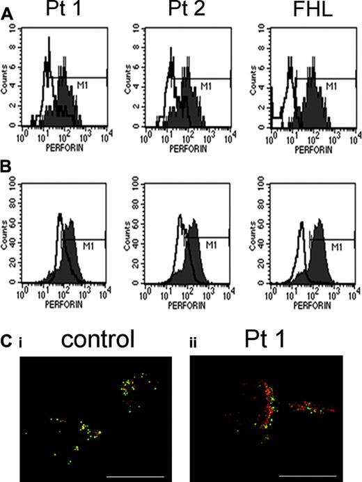 Figure 4. Reduced perforin expression in resting and activated NK cells of HPS2 patients. Expression profiles of perforin (mAb deltaG9) in unstimulated (A) and activated NK cells (B) from HPS2 patients (empty histograms) and from a perforin-deficient patient were overlaid with that of a healthy donor (filled histogram) to directly compare their fluorescence's mean. Pt 1: left panels; Pt 2: middle panels; perforin-deficient patient (FHL): right panels. Isotype-matched mouse IgG stained less than 0.1 % of cells. Expression of perforin was evaluated in parallel in NK cells from 10 healthy individuals. These experiments are representative of 5 independent experiments. (C) Confocal microscopy of perforin in IL-2–activated NK cells of HPS2 patients. NK cells from control donor (i) and Pt 1 (ii) were stained with antibodies against perforin (green) and Lamp-2 (red) as described in “Patients, materials, and methods.” Scale bars, 10 μm. Samples were analyzed using a Zeiss Axioplan 2 microscope (Carl Zeiss, Hertfordshire, United Kingdom) with Zeiss Plan-NEOFLUAR 100/1.3NA lenses mounted with a CoolSnap HQ camera (Roper Scientific, Tucson, AZ). Images were processed using Metamorph software (Molecular Devices, Downingtown, PA) and AutoDeblur + Autovisualize software (AutoQuant Imaging, Watervliet, NY).