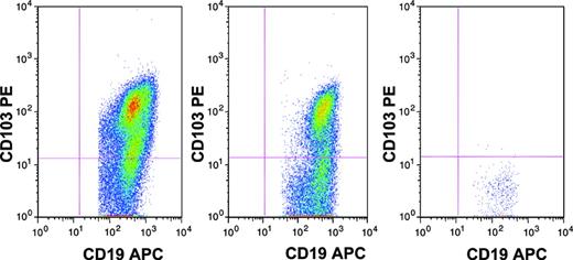 Figure 1. Assessment of hairy cells in a patient with HCL by flow cytometry performed on bone marrow aspirate specimen. CD19+ lymphocytes are shown. (A) Day 0, hairy cells are 10.7% of total cells. (B) Day 30 (after 2CDA), hairy cells are 11.0% of total cells. (C) Day 90 (after rituximab), hairy cells are undetectable, with fewer than 1/200 000 cells CD19+ with CD103 expression significantly above background.
