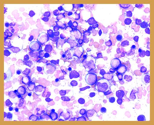 A bone marrow biopsy touch preparation from a patient with CN demonstrates increased numbers of myeloid precursors with a maturation at the promyelocyte/myelocyte stage of differentiation (courtesy of the ASH Slide Bank).