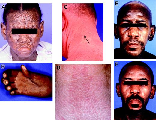 Figure 1. Clinical manifestations of scleromyxedema. (A-B) Patient 8: most severe facial papules (A) and sclerodactyly with joint contractures (B). (C) Patient 6: small waxy papules on the neck. (D) Patient 5: white ridges on neck. (E-F) Patient 4: before transplantation, with facial papules, glabellar thickening, and alopecia (E), and after transplantation (F), with resolution.