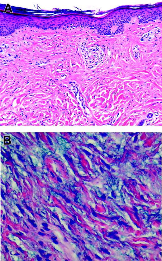 Figure 2. Histology of lesional skin biopsy. (A) Normal epidermis with a proliferation of fibroblasts (magnification, × 10). (B) Increased mucin deposition in the dermis (magnification, × 40). Images were obtained using an Olympus BX-40 microscope (Olympus, Melville, NY) and 10×/0.25 numeric aperture (NA) and 40×/0.65 NA objectives. Images were acquired using an Olympus DP10 camera and were processed using Adobe Photoshop 8.0 (Adobe Systems, San Jose, CA).