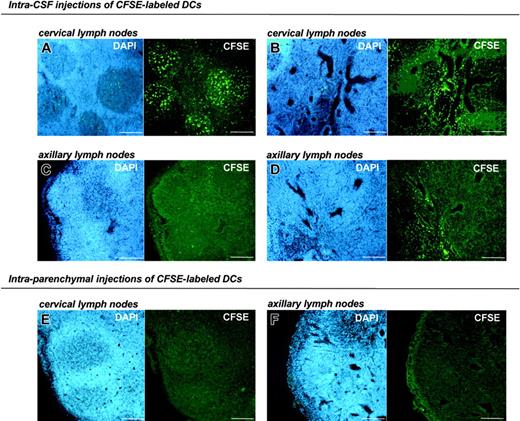Figure 4. Cervical lymph node targeting of CSF-injected DCs. Bone marrow-derived DCs were labeled with CFSE then injected into the CSF (A-D) or brain parenchyma (E-F) of normal rats. Histologic examination of cervical or axillary lymph nodes was performed by fluorescence microscopy after counterstaining with DAPI for nuclei visualization (blue). Photomicrographs show representative results obtained from analyzing lymph nodes on day 3 after injection. (A-B) In the cervical lymph nodes, numerous labeled cells are detected within B-cell cortical follicles (A) and in the medulla (B). (C-D) Only occasional labeled cells are detected in axillary lymph nodes and are mainly localized in the medulla. (E-F) Following injections of DCs into brain parenchyma, no labeled cells are observed in cervical (E) or axillary lymph nodes (F). Scale bars: 200 μm.