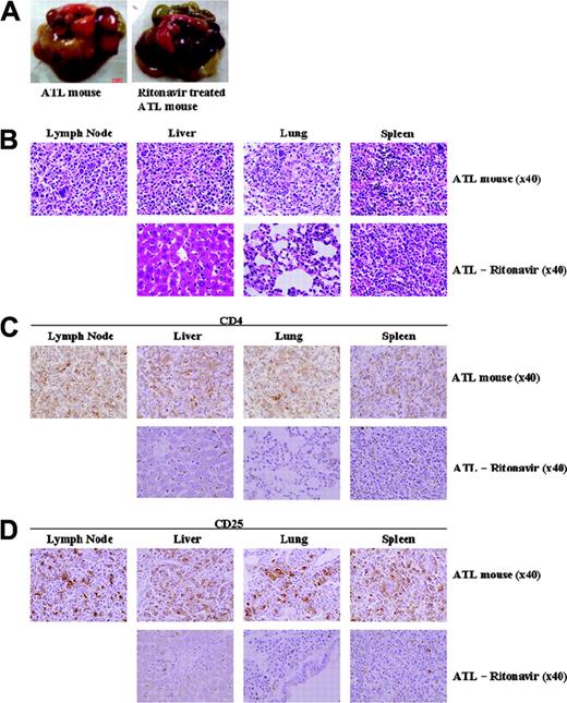 Figure 5. Effect of ritonavir on ATL cell growth and infiltration. (A) Mice were injected with ATL cells (2 × 107 cells) subcutaneously in the postauricular region. One day after inoculation, the mice were administered either RPMI 1640 or ritonavir (30 mg/kg/d) intraperitoneally every day for 30 days followed by observation for another month without therapy. Photographs of whole organs of RPMI 1640-treated ATL mice (left) and ritonavir-treated ATL mice (right) with enlarged spleen, liver, and lungs. (B-D) HE staining (B) and immunohistochemical staining using anti-CD4 (C) or anti-CD25 (D) in various organs of NOG mice 2 months after inoculation of ATL cells. Upper panels show various organs of mice treated with RPMI 1640, and lower panels represent various organs of mice treated with ritonavir. Magnification ×40.
