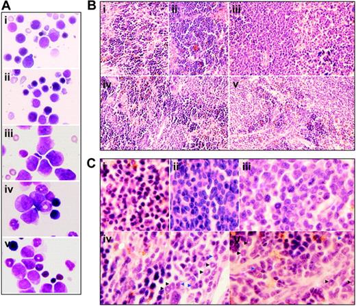 Figure 4. Histologic features of spleen of leukemic mice that received transplants under intermittent hypoxia. (A) In the same experiments as those described in Figure 2, splenocytes were collected onto slides by cytospin, stained by Wright Giemsa, and observed under a microscope (original magnification × 100/1.30 NA oil objective lens). (B-C) Histopathologic sections were stained with H&E (B, original magnification × 10/0.30 NA PH1 objective lens; C, original magnification × 100/1.30 NA oil objective lens). Arrowheads indicate mature myeloid cells with ring- (black) or horseshoe-shaped (blue) nuclei. Symbols i to v represent mice with the same treatment as in Figure 2.