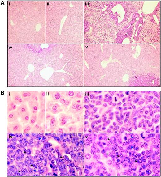Figure 5. Histologic features of liver in leukemic mice that received transplants in intermittent hypoxia. In the same experiments as those described in Figure 2, histopathologic sections were stained with H&E for liver (A, original magnification × 10/0.30 NA PH1 objective lens; B, original magnification × 100/1.30 NA oil objective lens). Arrowheads indicate mature myeloid cells with ring- (black) or horseshoe-shaped (blue) nuclei. Symbols i to v represent mice with the same treatment as in Figure 2.