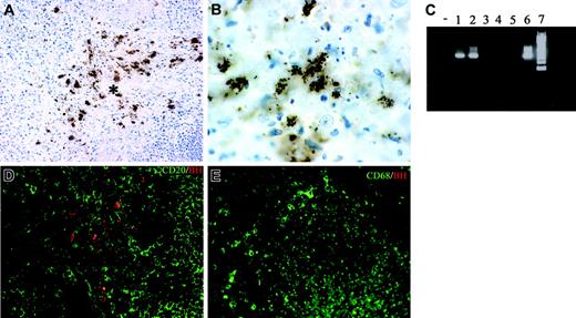 Figure 5. Tissue identification of B henselae in suppurative lymphadenitis. (A-B, D) Immunohistochemistry of lymph node sections from a CSD case using anti-BH illustrates the location of B henselae bacilli. Reactivity is particularly obvious within the necrotic area (* in A) where positive bacilli are found as small clusters or single elements as illustrated by the high-power field in panel B. Double staining using CD20, CD68, and anti-BH shows B henselae bacilli intermingled with CD20+ B cells (D) and CD68+ macrophages (E). (C) Expression of B henselae DNA was determined by PCR amplification using specific primers. Lane – indicates no template; lanes 1-2, CSD cases; lanes 3-5, mycobacterial lymphadenitis cases; lane 6, positive control (B henselae–infected DCs); lane 7, molecular weight ladder. Immunoperoxidase technique for anti-BH counterstained with Meyer hematoxylin (A-B). Combined immunoperoxidase and immunofluorescence for anti-BH and CD20 or CD68 (D-E; see “Tissues and staining procedures” for details). Original magnification, × 200 (A,D,E) and × 600 (B).