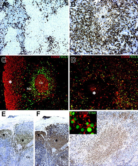 Figure 6. Monocytoid B cells populate B henselae–induced granuloma and express the TCL1– T-bet+ phenotype. Whereas in mycobacterial lymphadenitis only scattered CD20+ B cells surround the epithelioid granulomas (A), in a case of CSD suppurative granuloma numerous CD20+ B cells are found surrounding a central necrotic focus (*; B). (C) Double immunostaining for CD20 (red) and TCL1 (green) illustrates the distribution of TCL1+ cells in a reactive lymph node: nuclear expression of TCL1 is observed in a subset of CD20+ mantle B cells (Mn), in scattered CD20– cells in the interfollicular area, and in germinal center B cells (Gc), whereas the majority of subcapsular monocytoid B cells (*) are negative (C). In CSD granuloma (D) the majority of CD20+ B cells associated with the granuloma are TCL1–, whereas a mixture of double CD20+ TCL1+ and single CD20+ cells is found outside the granuloma. (E-F) Serial sections from a case of HIV lymphadenitis are stained for T-bet (E) and CD20 (F). Strong nuclear expression of T-bet is observed in clusters of CD20+ monocytoid B cells (*), whereas no reactivity is observed in other CD20+ follicular B cells (Gc indicates a germinal center). Numerous T-bet+ cells are associated with the CSD granuloma (G) and many of them coexpress CD20 (G inset). Immunoperoxidase technique for CD20 (A-B) and T-bet (E-G) counterstained with Meyer hematoxylin. Double immunofluorescence for CD20 (red), TCL1 (green), and T-bet (green) (C-D, G). Original magnifications, × 100 (A, E, F, G), × 200 (B-D), and × 600 (G inset).